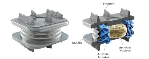 Spinal Kinetics M6 Disc Replacement